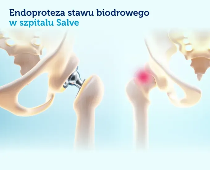 endoproteza-stawu-biodrowego-w-szpitalu-salve.webp.webp