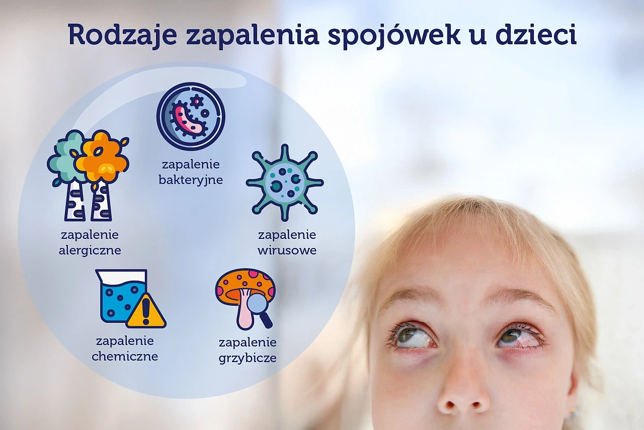 zapalenie spojowek.webp [111.01 KB]