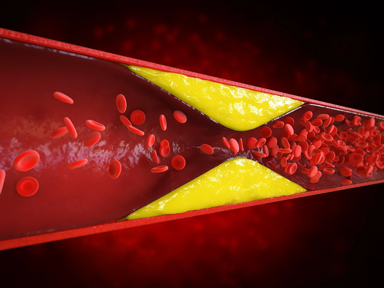Hipercholesterolemia - przyczyny objawy leczenie - tekst.webp [122.44 KB]