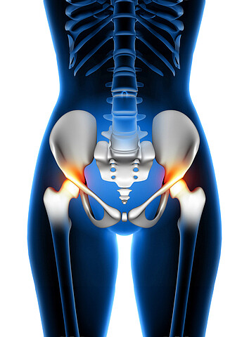 endoproteza-biodra-salve-lodz.jpg [145.58 KB]