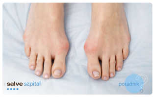 Haluksy - czym są i kogo mogą dotyczyć?